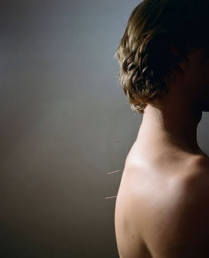 Discover the best acupuncture on the Upper West Side. Expert treatments for pain relief, stress reduction, and overall wellness. Book today.